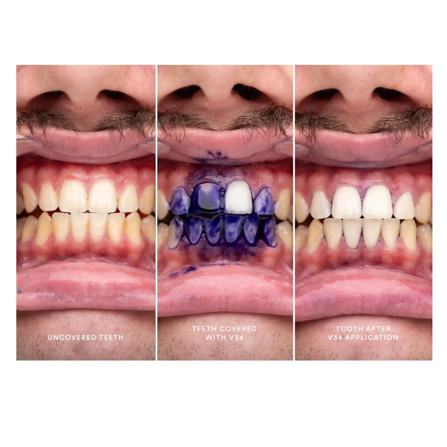 🦷 HISMILE™ – Blanqueador Dental+Obsequio