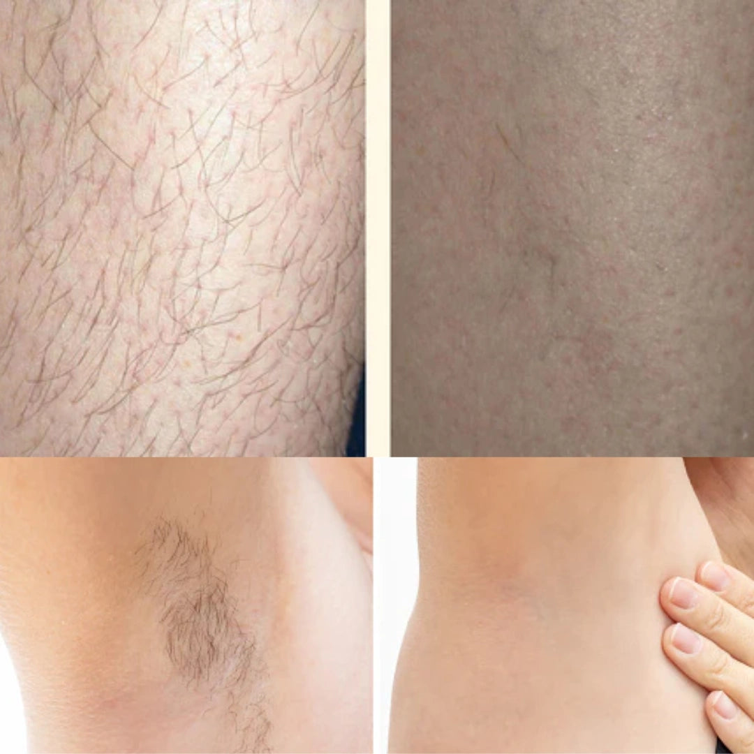 Depiladora Láser Masculina y Femenina